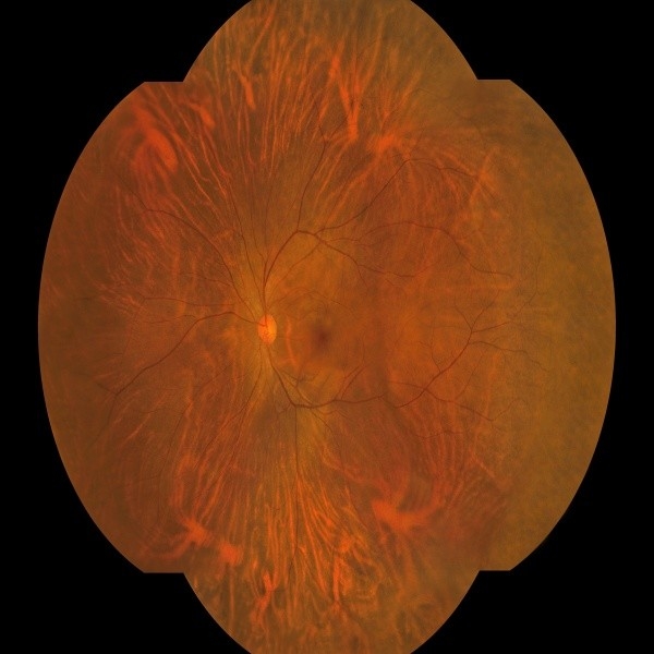 Caméra de fond à grand angle de 176 degrés avec fonctionnement à une clé et capture binoculaire pour appareils médicaux ophtalmiques